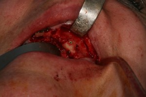 greffes osseuse implants dentaires