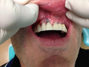 implants dentaires trinon