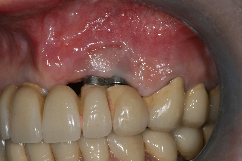 Danger implants dentaires trinon