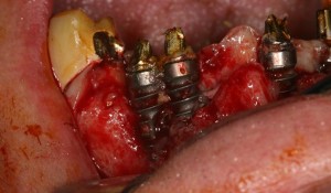 implant trinon Dr Hascoet 