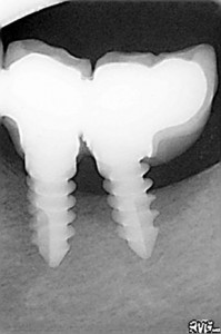 Implant dentaire trinon travail baclé du Dr Hascoet thierry