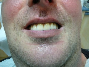 résultat implants dentaires après